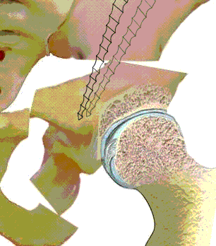 חיתוך עצם שיחזורי - עצם הירך עם דיספלזיה לאחר ניתוח